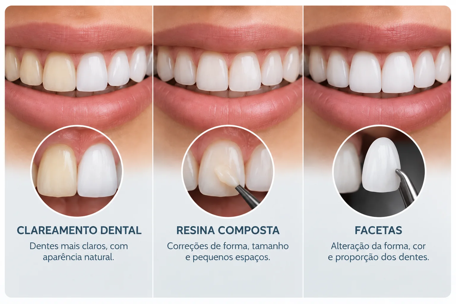Comparação ilustrativa entre clareamento dental, resina composta e facetas