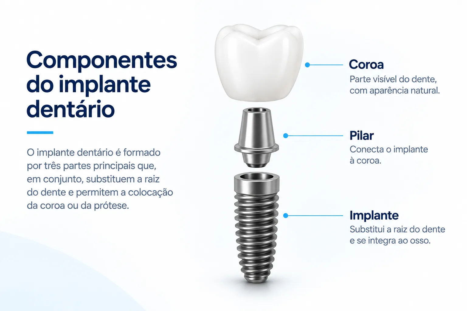 Componentes de um implante dentário: coroa, pilar e implante