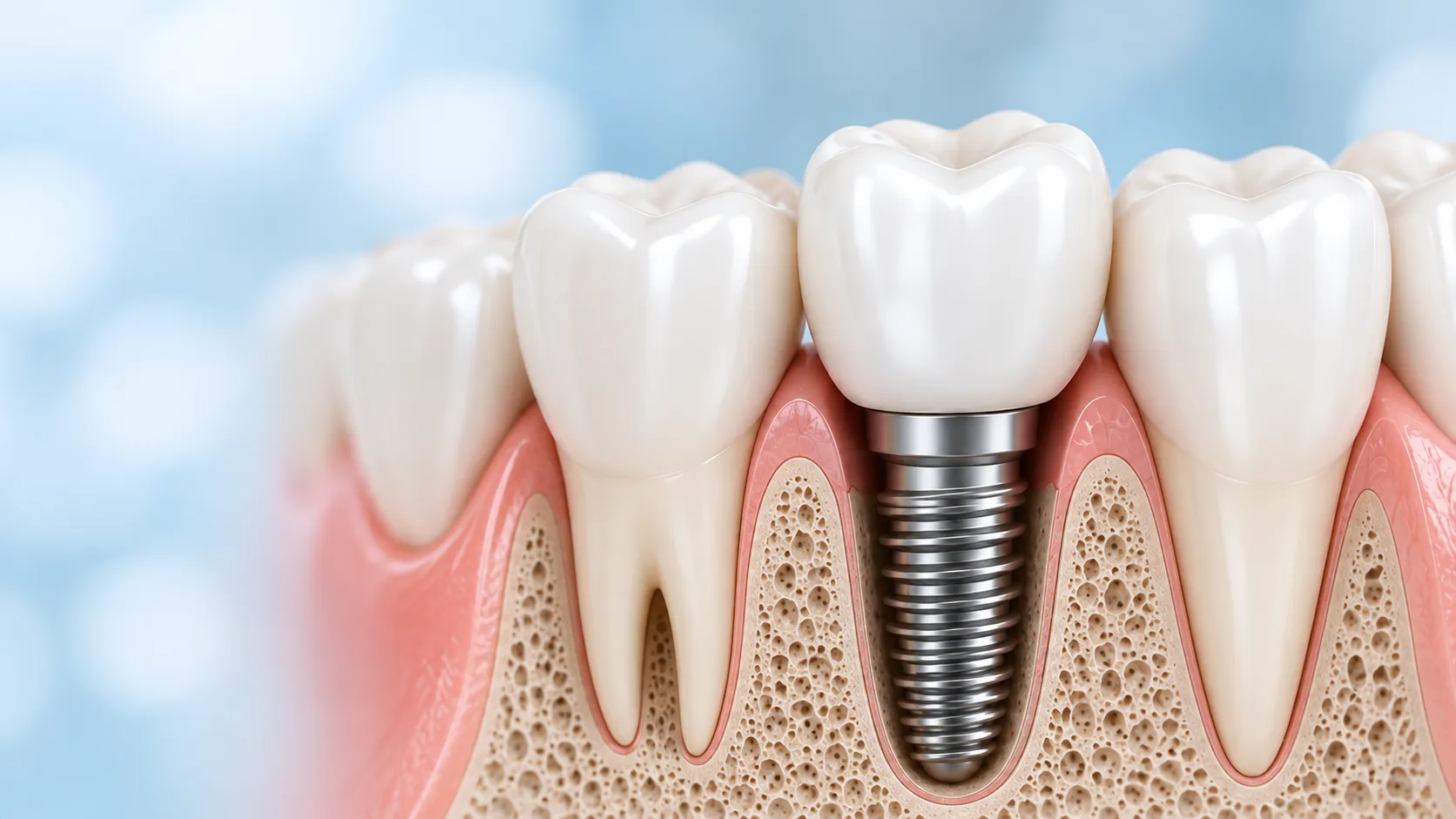 Implante dentário instalado no osso ao lado de dentes naturais