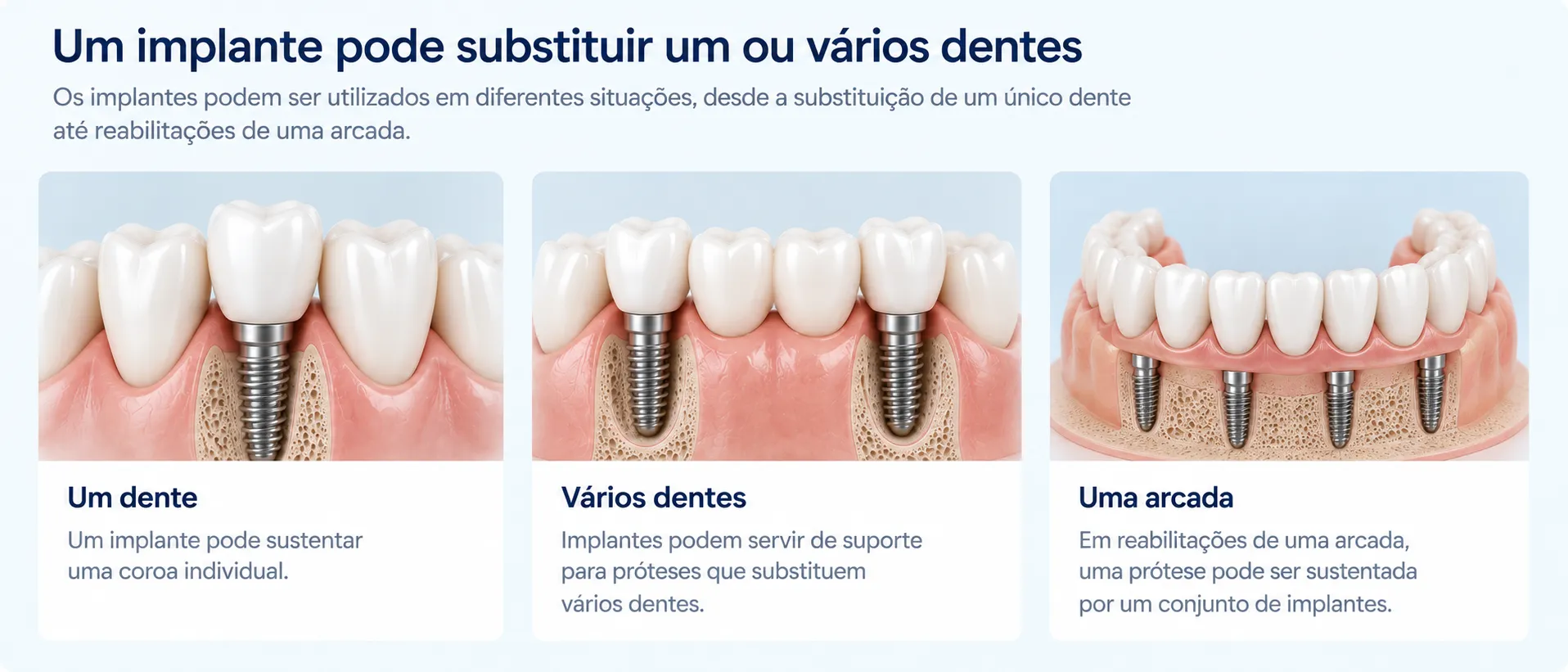 Exemplos de implantes para substituir um dente, vários dentes ou uma arcada
