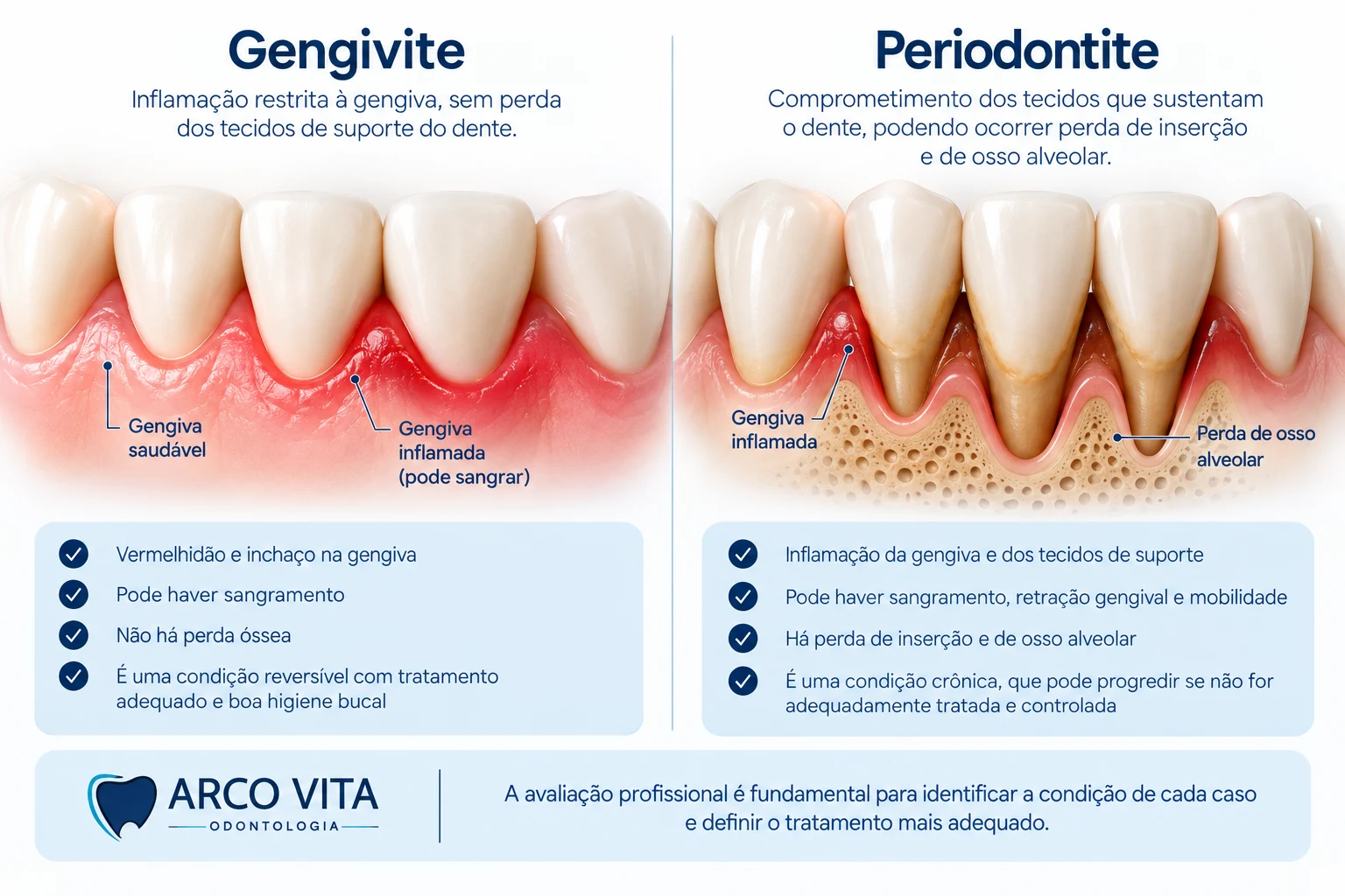 Ilustração comparando gengivite e periodontite, mostrando inflamação gengival e perda de suporte ósseo.