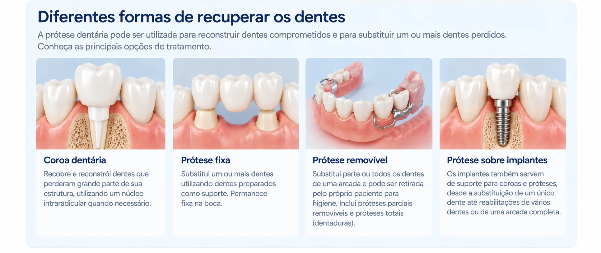 Infográfico sobre coroa dentária, prótese fixa, prótese removível e prótese sobre implantes